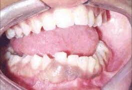 দাঁত আঁকাবাঁকা হলে কি করবেন?