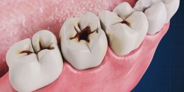 ডেন্টাল ক্যারিজ কি ?