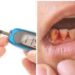 ডায়াবেটিসে দাঁতের রোগের ঝুঁকি বাড়ে