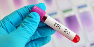 রক্তে ইএসআর (ESR) রেট কমবেশি কেন হয়?