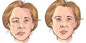 ফেসিয়াল প্যারালাইসিস বা মুখের পক্ষাঘাত