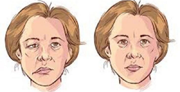 ফেসিয়াল প্যারালাইসিস বা মুখের পক্ষাঘাত