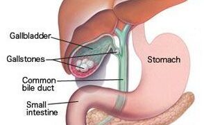 পিত্তথলির পাথর : কারণ ও চিকিৎসা