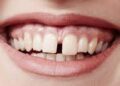 ফাঁকা দাঁত ঠিক করার উপায়