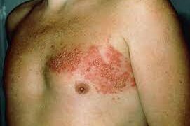 চর্ম রোগ হারপিস জস্টার