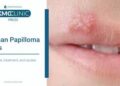 এইচপিভি: এই যৌন ভাইরাস নিয়ে যত লজ্জা ও অজ্ঞতা