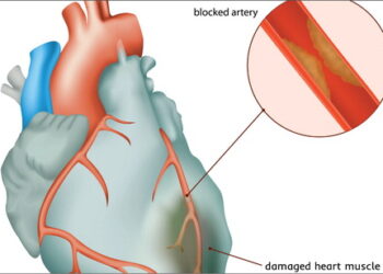 অপারেশন ছাড়াই হার্টের রক্তনালী ব্লকের চিকিৎসা!
