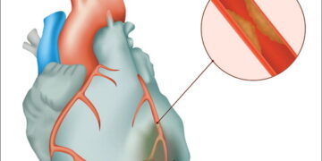 অপারেশন ছাড়াই হার্টের রক্তনালী ব্লকের চিকিৎসা!