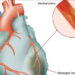 অপারেশন ছাড়াই হার্টের রক্তনালী ব্লকের চিকিৎসা!