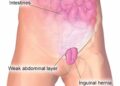 ইনগুইনাল হার্নিয়া