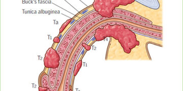 লিঙ্গের ক্যান্সার