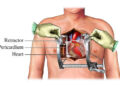ওপেন হার্ট সার্জারি: কখন দরকার হয়, কীভাবে করা হয়?