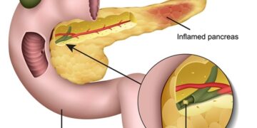 অগ্ন্যাশয়ের ইনফেকশন, প্যানক্রিয়াটাইটিস