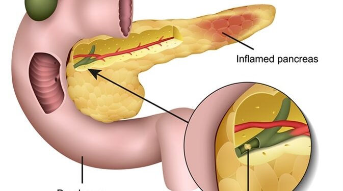 অগ্ন্যাশয়ের ইনফেকশন, প্যানক্রিয়াটাইটিস