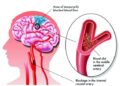 ব্রেইন স্ট্রোক কি? স্ট্রোক এর কারণ, চিকিৎসা এবং প্রতিরোধ