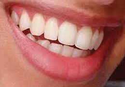 দাঁতের কালচে দাগ দূর করার ঘরোয়া উপায়