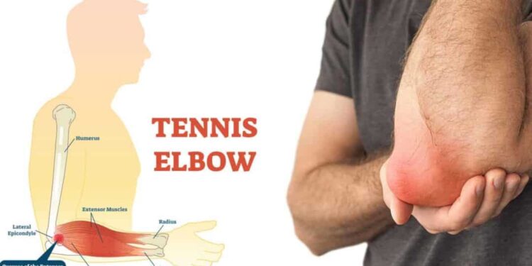 কনুইয়ে ব্যথা টেনিস এলবো