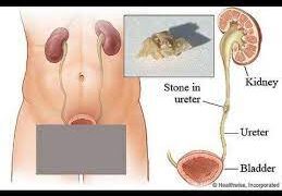 মূত্রনালির পাথর