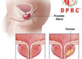 প্রস্টেট গ্ল্যান্ডের ক্যানসার !