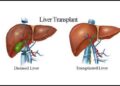 লিভার প্রতিস্থাপন বলতে এবং কিভাবে ?