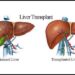 লিভার প্রতিস্থাপন বলতে এবং কিভাবে ?