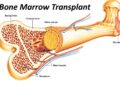 বোন ম্যারো ট্রান্সপ্ল্যান্টেশান (অস্থিমজ্জা প্রতিস্থাপন)