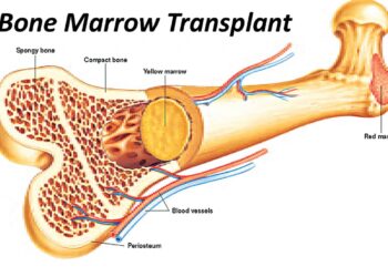 বোন ম্যারো ট্রান্সপ্ল্যান্টেশান (অস্থিমজ্জা প্রতিস্থাপন)