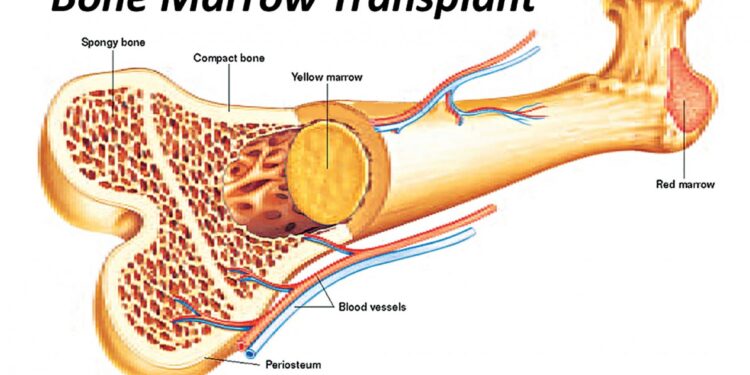 বোন ম্যারো ট্রান্সপ্ল্যান্টেশান (অস্থিমজ্জা প্রতিস্থাপন)