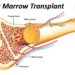বোন ম্যারো ট্রান্সপ্ল্যান্টেশান (অস্থিমজ্জা প্রতিস্থাপন)