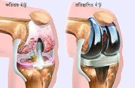 হাঁটুর আর্থোপ্লাস্টি : সম্পূর্ণ হাঁটু প্রতিস্থাপন