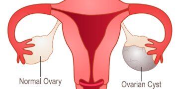 ওভারিয়ান সিস্টেকটমি : ডিম্বাশয়ের সার্জারী