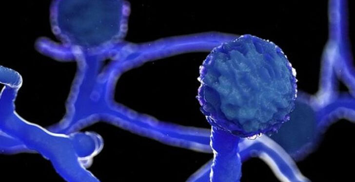 আরো ১জন ব্ল্যাক ফাঙ্গাসে আক্রান্ত রোগী চমেকে চিকিৎসাধীন !