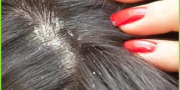 খুশকি দূর করার ঘরোয়া উপায়