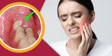 আক্কেল দাঁতের ব্যথায় করণীয়