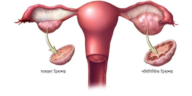 পলিসিস্টিক ওভারিয়ান সিনড্রোম নিয়ে কিছু কথা