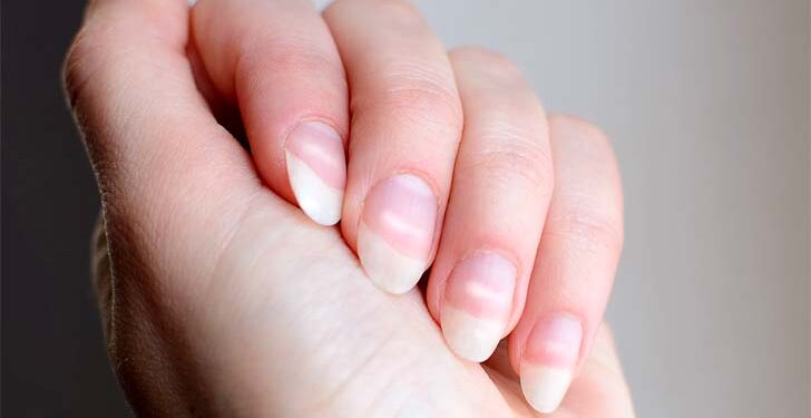 নখে ‘মিল্ক স্পট’ হয় যে কারণে