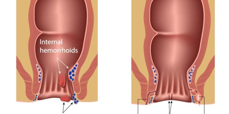 পায়ুপথের রোগ মানেই পাইলস নয়