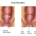 পায়ুপথের রোগ মানেই পাইলস নয়