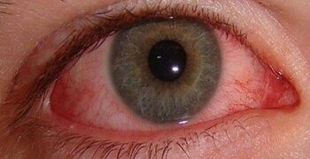 চোখের রোগে ইনজেকশন ও গ্লুকোমা রোগের জরুরি তথ্য