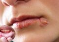 জ্বরঠোসা হয় কেন? জানুন প্রতিকারের উপায়