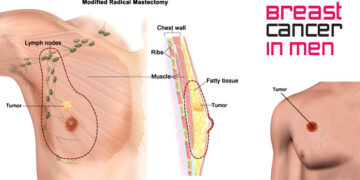 পুরুষের ব্রেস্ট ক্যান্সারের প্রধান ৪ লক্ষণ জেনে নিন