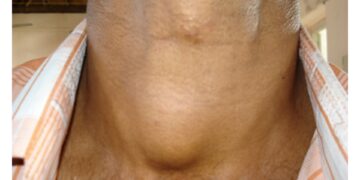 দেশে থাইরয়েড রোগী ৫ কোটি, ৩ কোটি জানেন না তারা আক্রান্ত