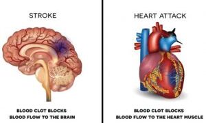 ব্রেইন স্ট্রোক না কি হার্ট অ্যাটাক যেভাবে বুঝবেন