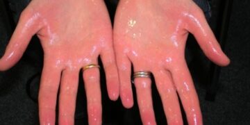 হাতের তালু, পায়ের পাতা খুব ঘামে - কি করি ?