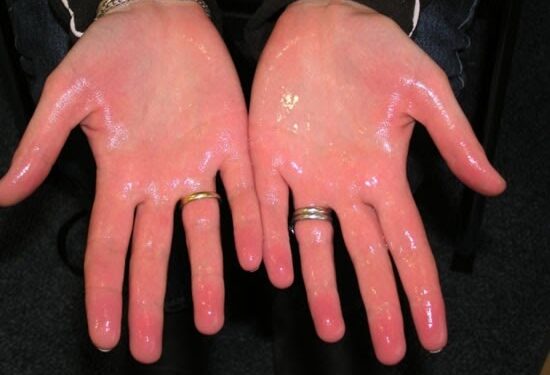 হাতের তালু, পায়ের পাতা খুব ঘামে - কি করি ?