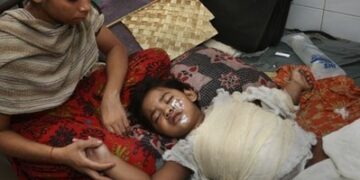 দেশের পাঁচ হাসপাতালে হচ্ছে পূর্ণাঙ্গ বার্ন অ্যান্ড প্লাস্টিক সার্জারি ইউনিট
