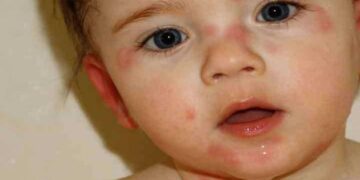 নবজাতকের ছয় চর্মরোগ, করণীয়