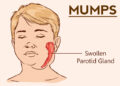 মাম্পস :গাল ফোলা রোগ