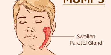 মাম্পস :গাল ফোলা রোগ