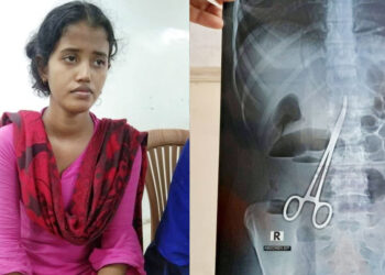 পেটে কাঁচি রেখেই সেলাই, ৬৪৩ দিন পর অপসারণ